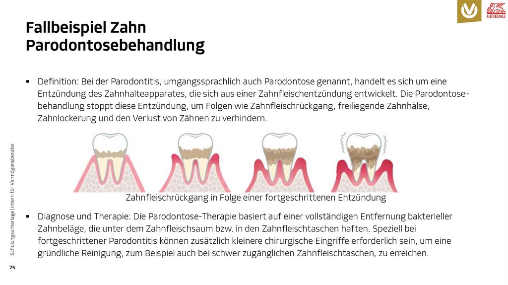 Fallbeispiel Zahn Parodontosebehandlung