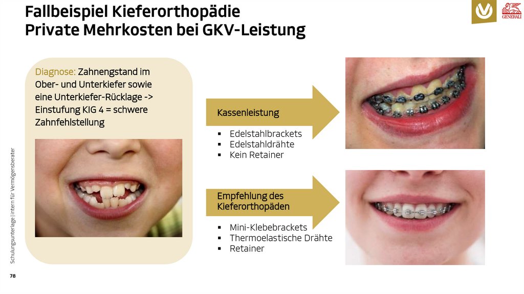 Fallbeispiel Kieferorthopädie Private Mehrkosten bei GKV-Leistung