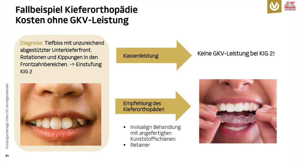 Fallbeispiel Kieferorthopädie Kosten ohne GKV-Leistung