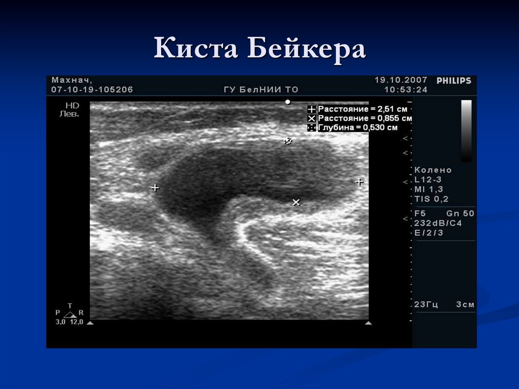 Киста Бейкера