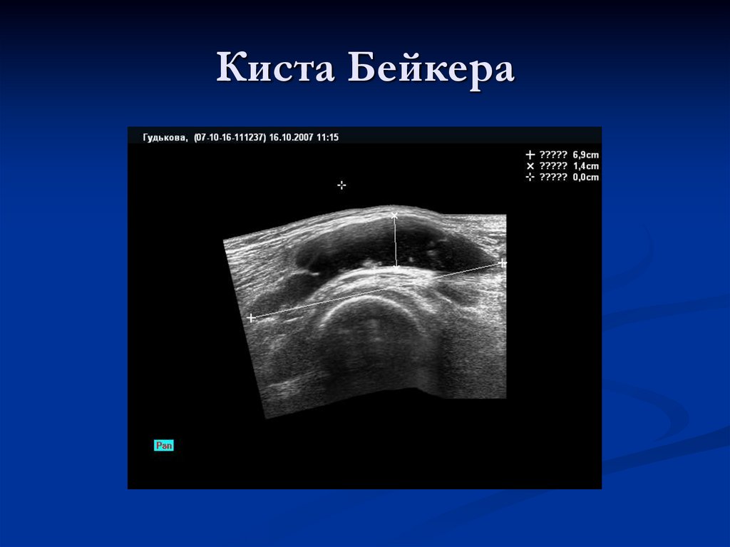 Киста Бейкера