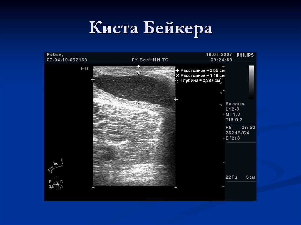 Киста Бейкера