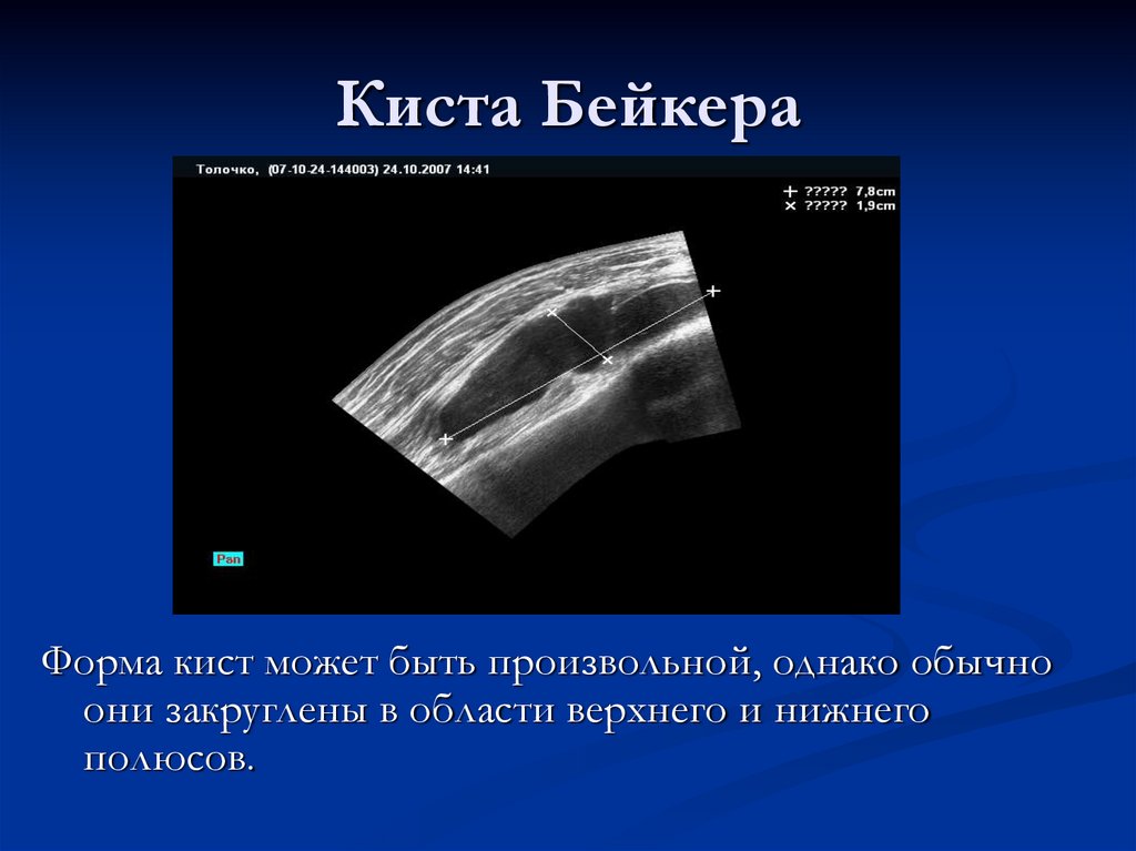 Киста Бейкера