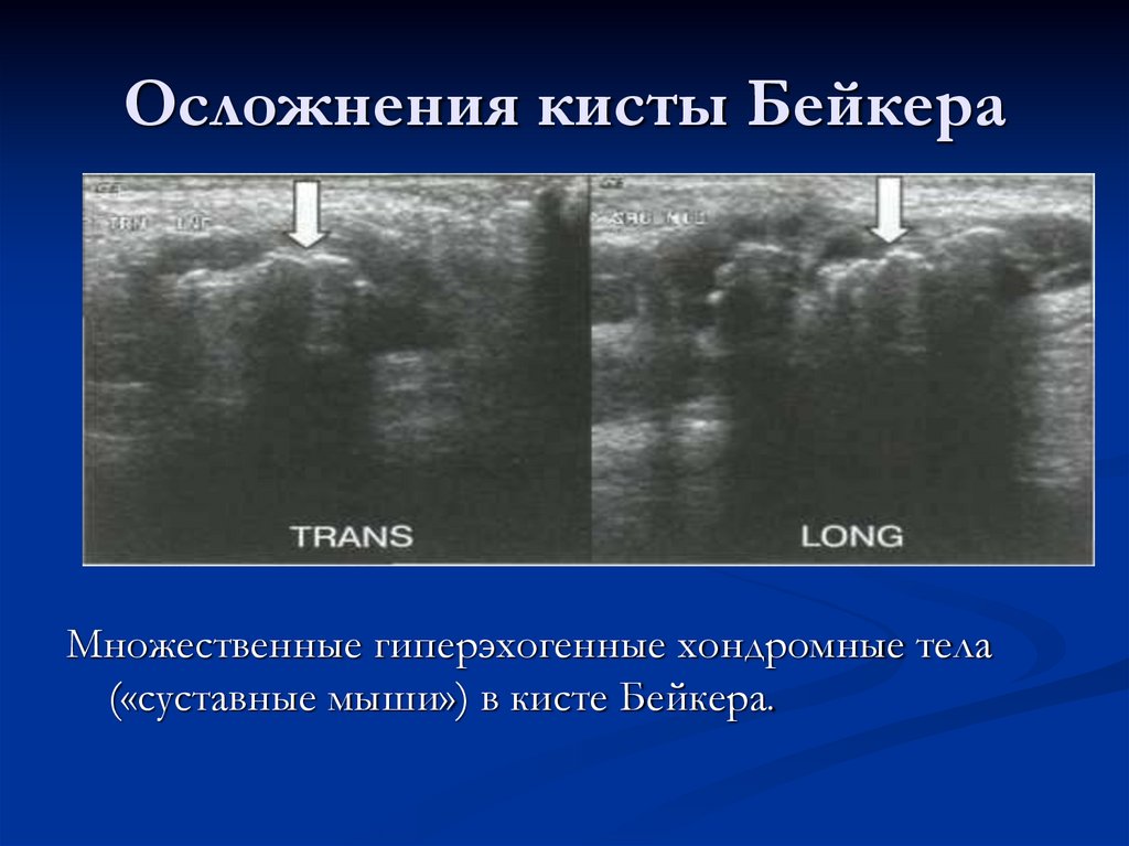 Осложнения кисты Бейкера