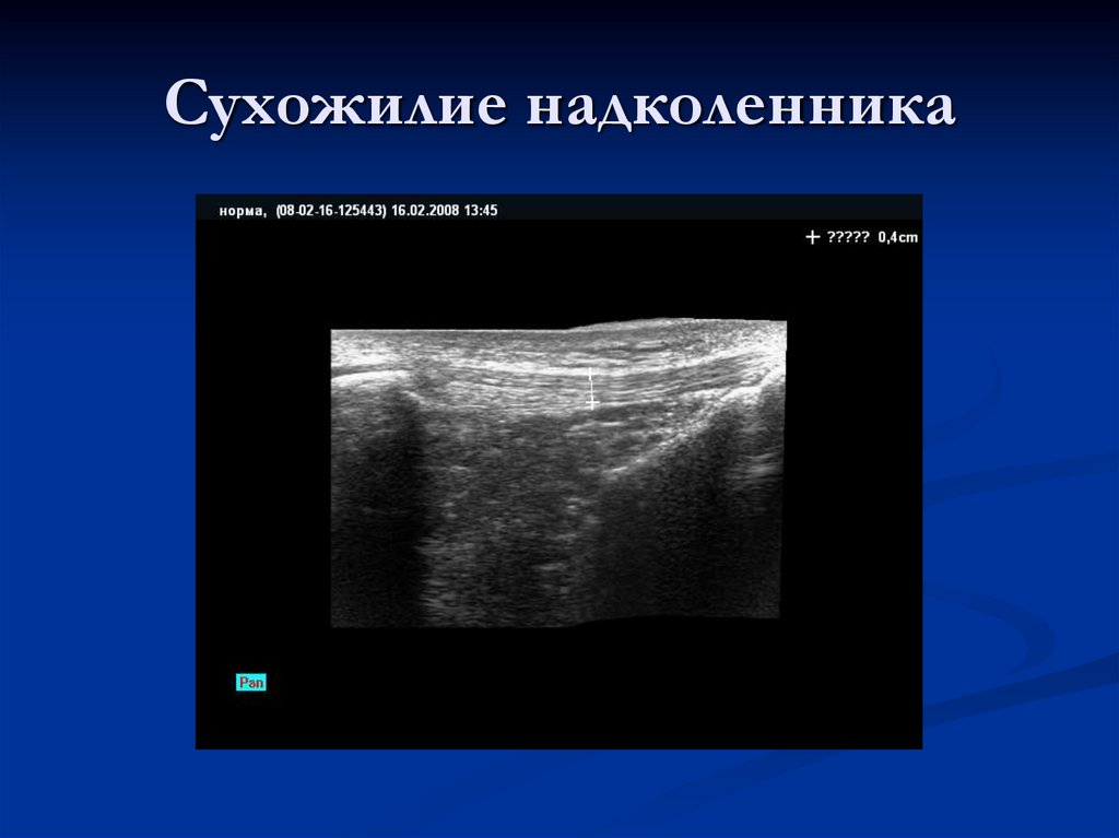 Сухожилие надколенника