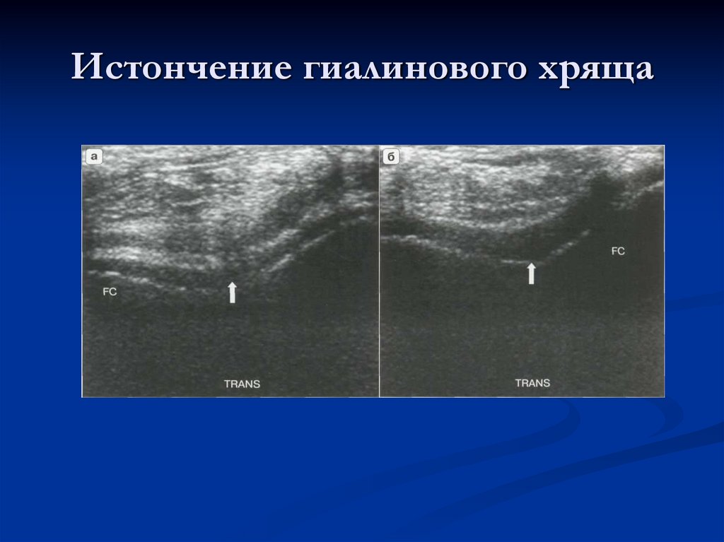 Истончение гиалинового хряща