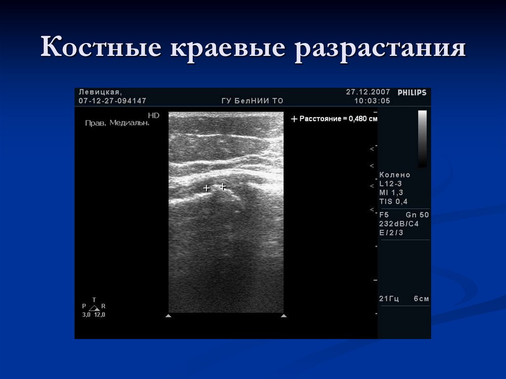 Костные краевые разрастания