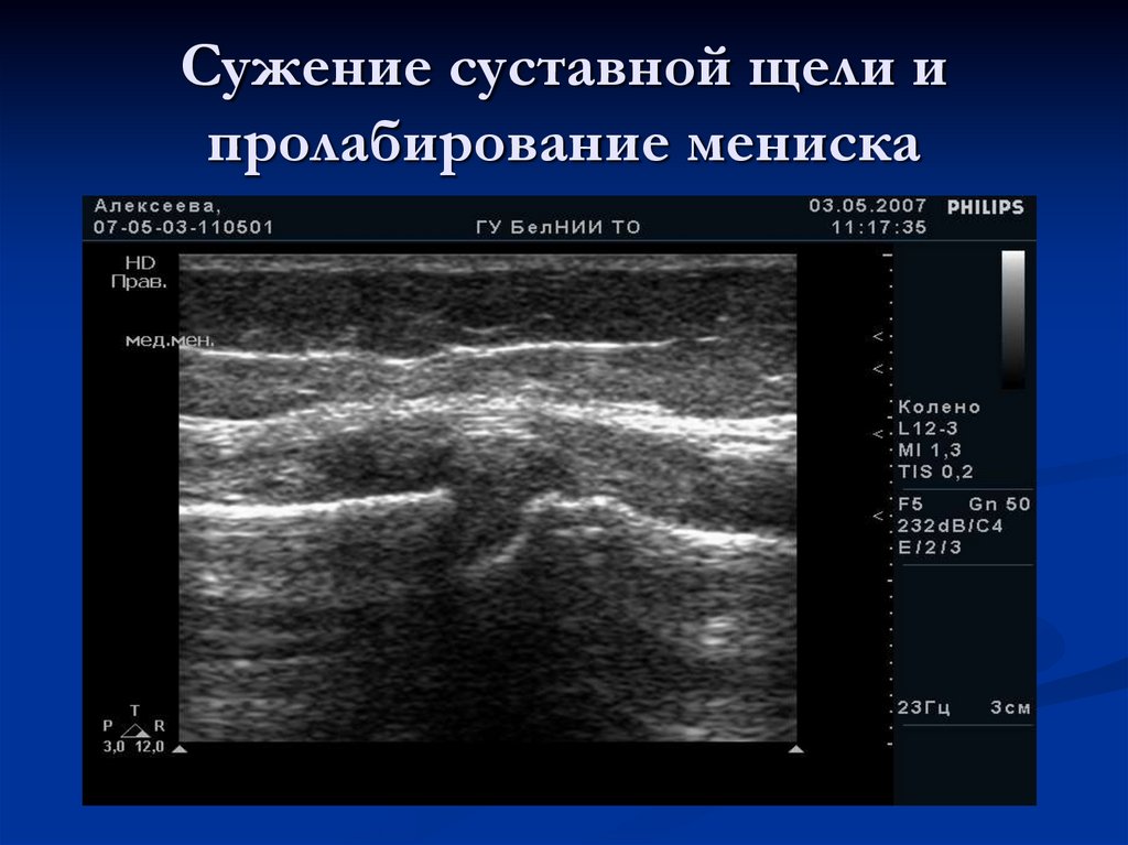 Сужение суставной щели и пролабирование мениска