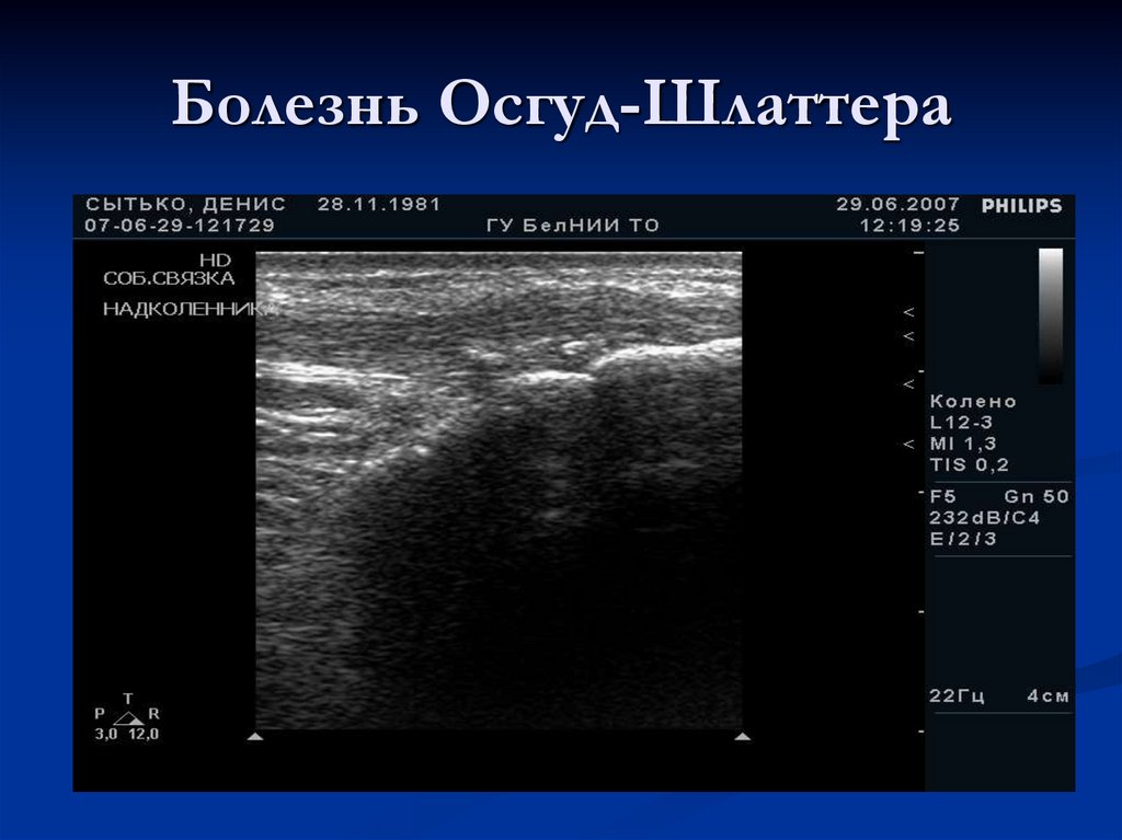 Болезнь Осгуд-Шлаттера