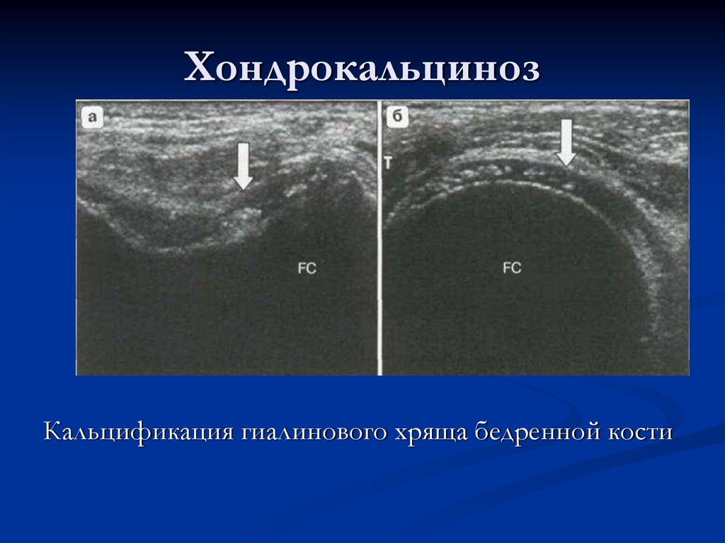 Хондрокальциноз