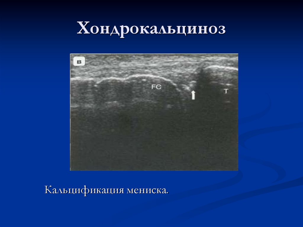 Хондрокальциноз