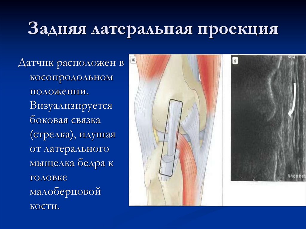 Задняя латеральная проекция