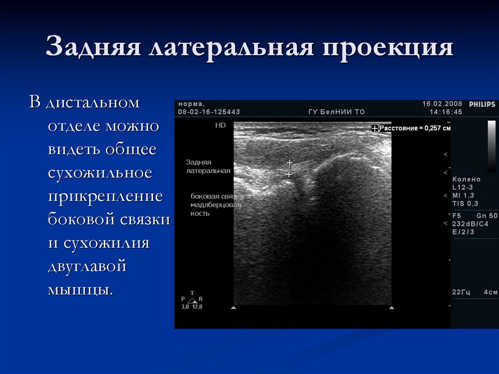 Задняя латеральная проекция