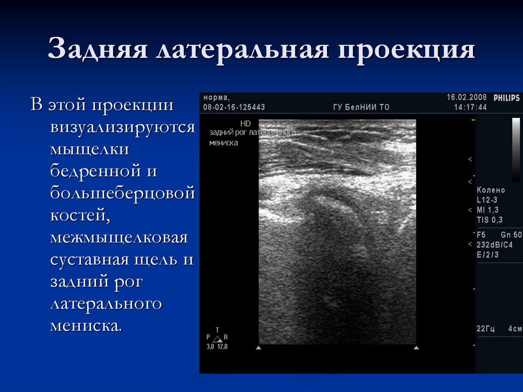 Задняя латеральная проекция