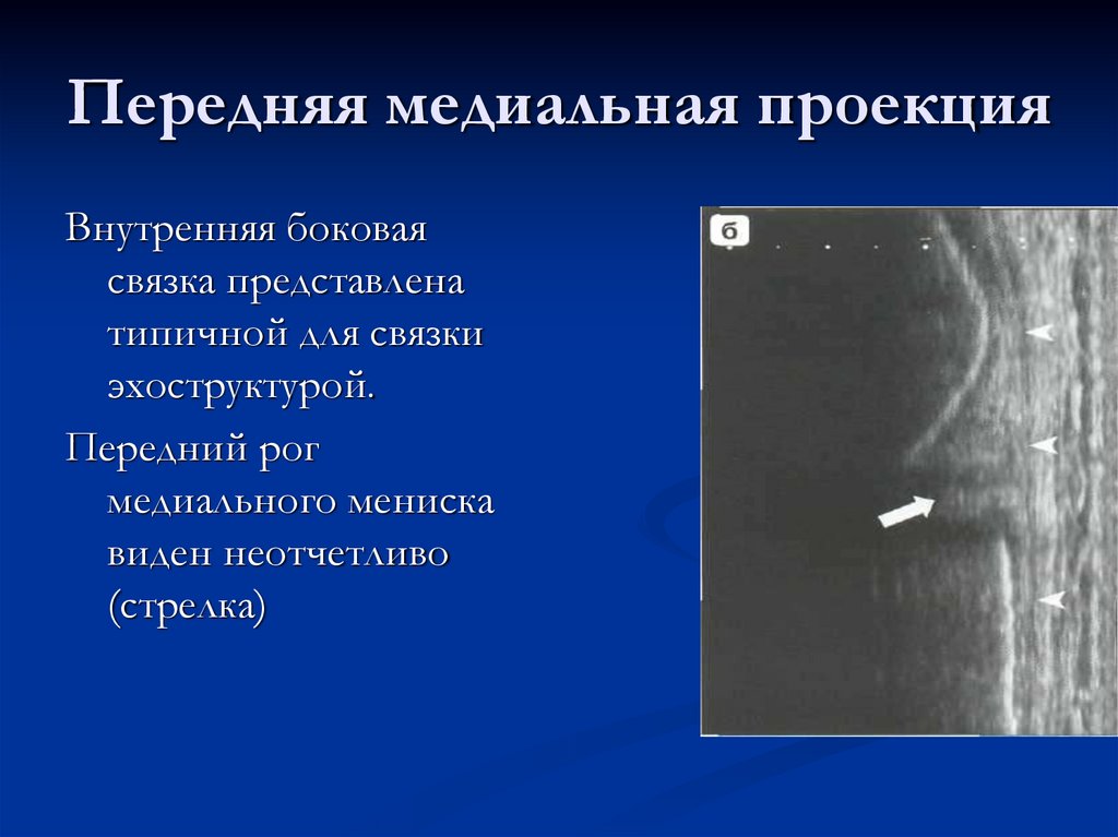 Передняя медиальная проекция