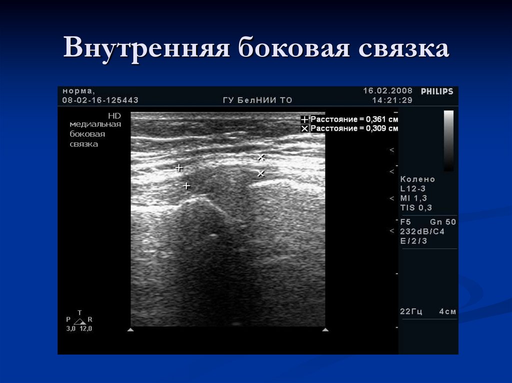 Внутренняя боковая связка