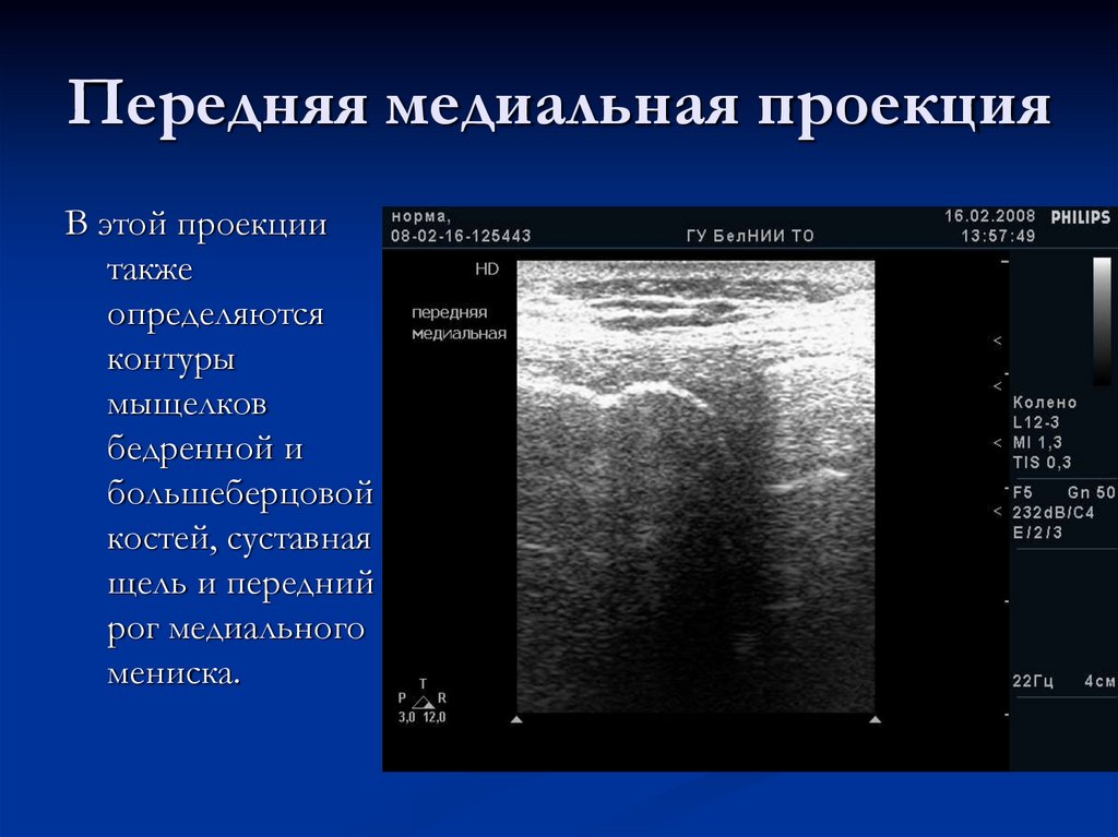 Передняя медиальная проекция