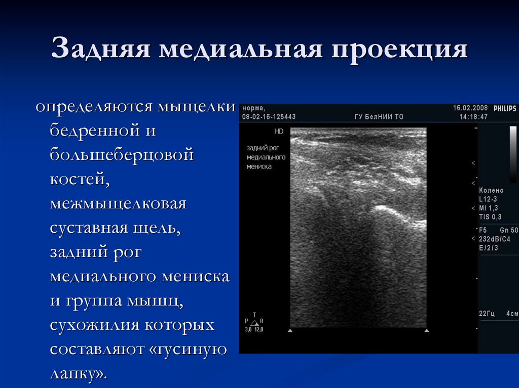 Задняя медиальная проекция