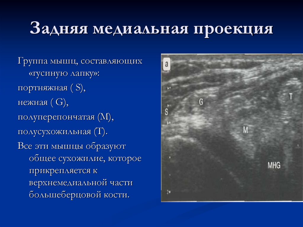 Задняя медиальная проекция