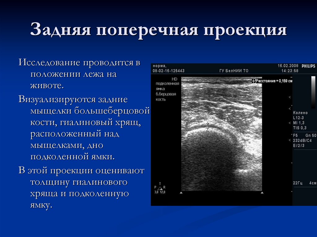 Задняя поперечная проекция