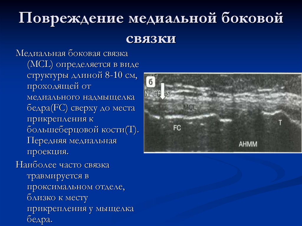 Повреждение медиальной боковой связки