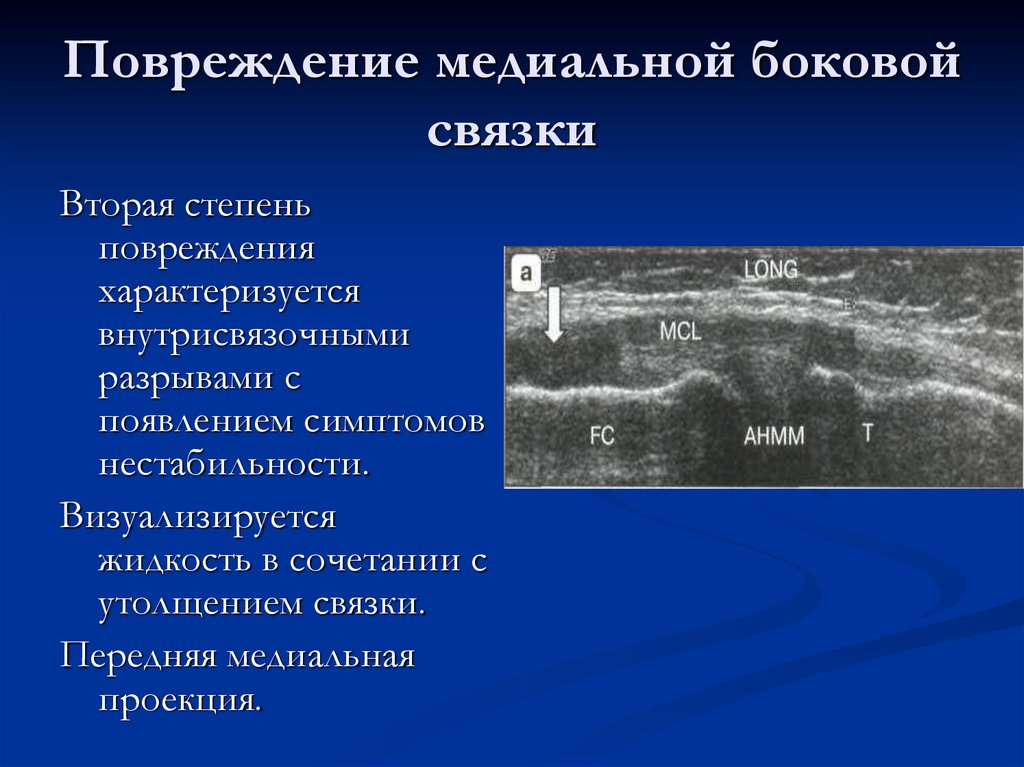 Повреждение медиальной боковой связки