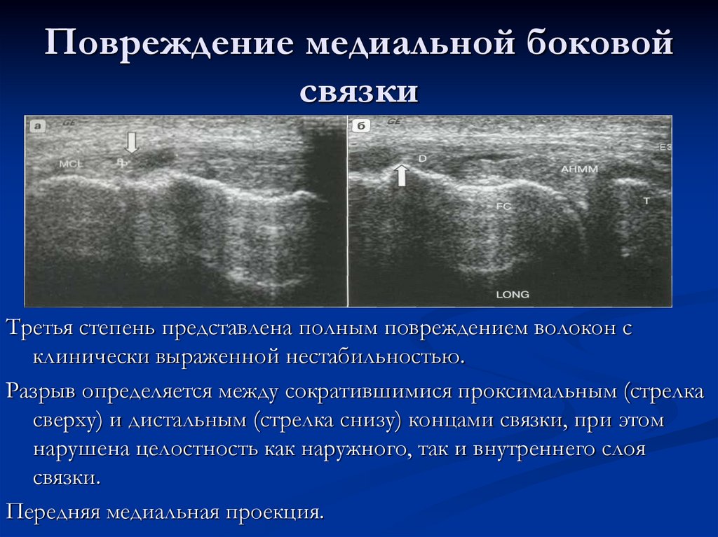 Повреждение медиальной боковой связки