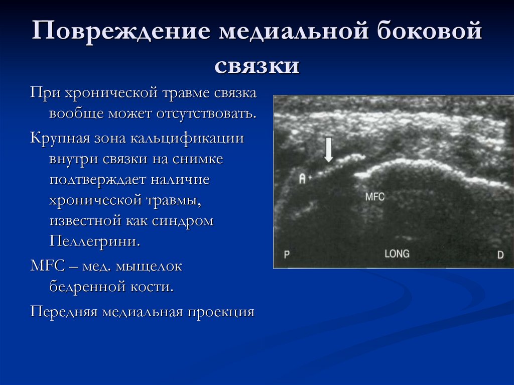 Повреждение медиальной боковой связки