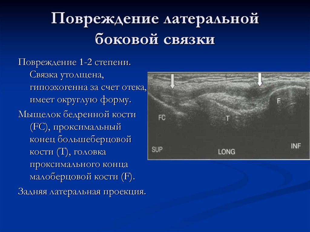 Повреждение латеральной боковой связки