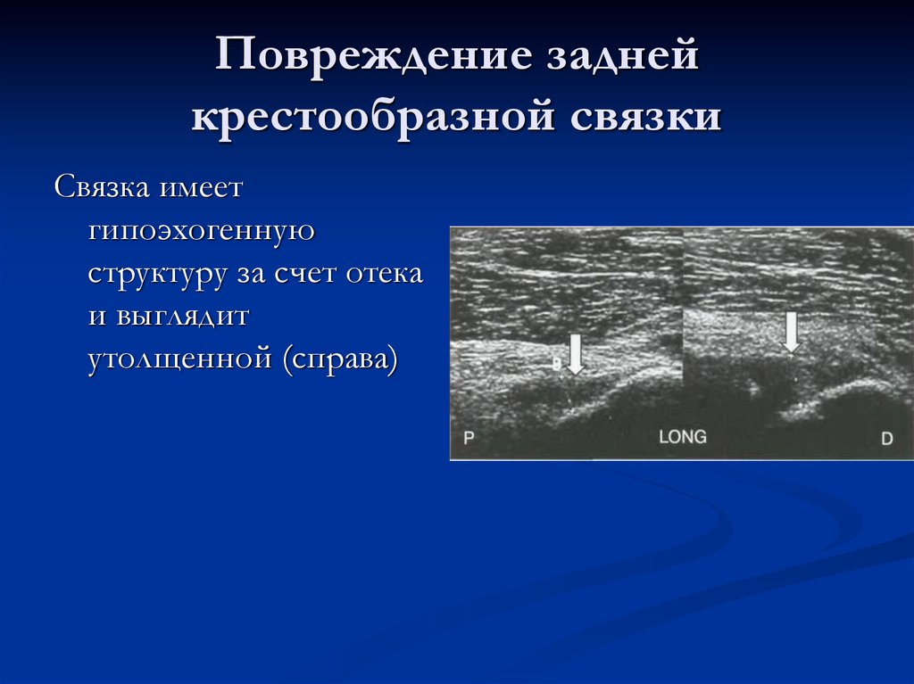 Повреждение задней крестообразной связки