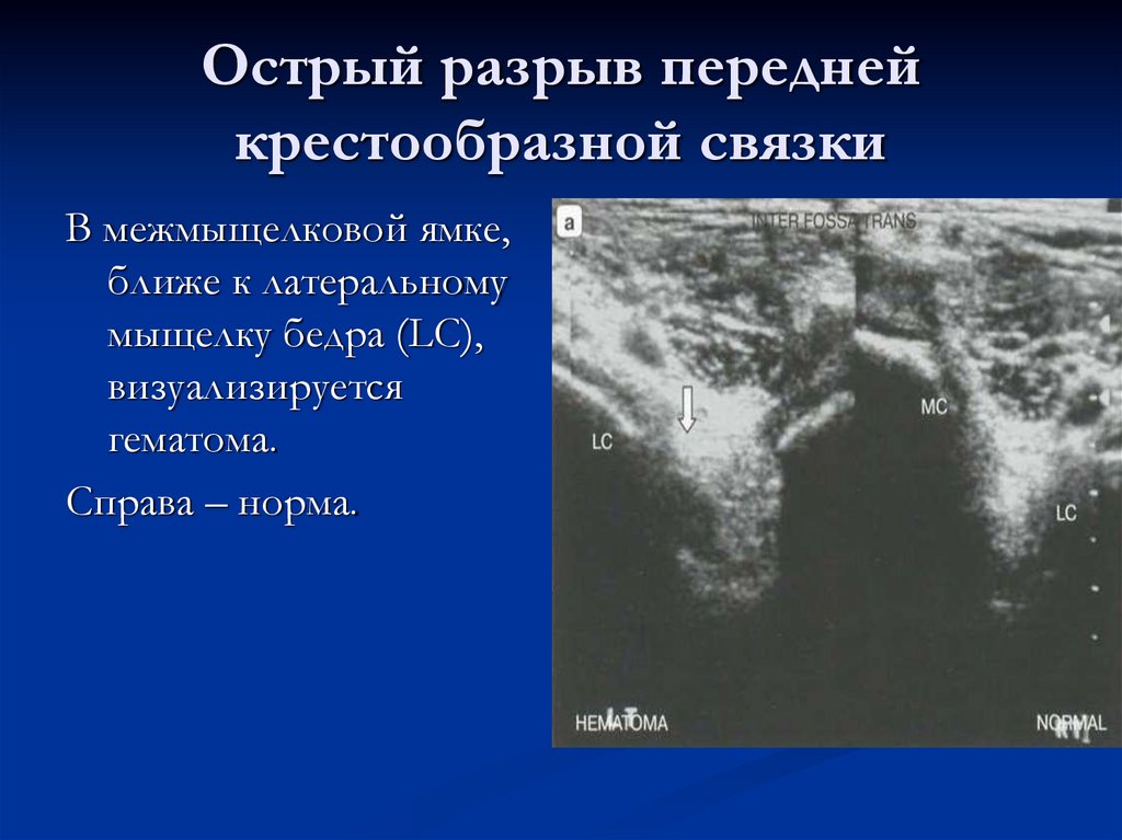 Острый разрыв передней крестообразной связки