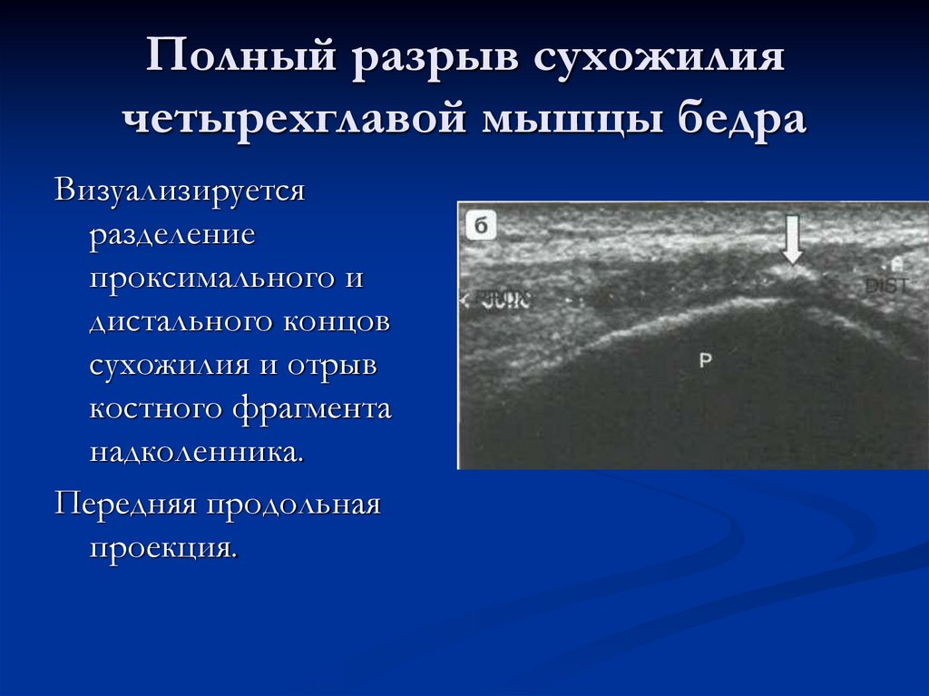 Полный разрыв сухожилия четырехглавой мышцы бедра