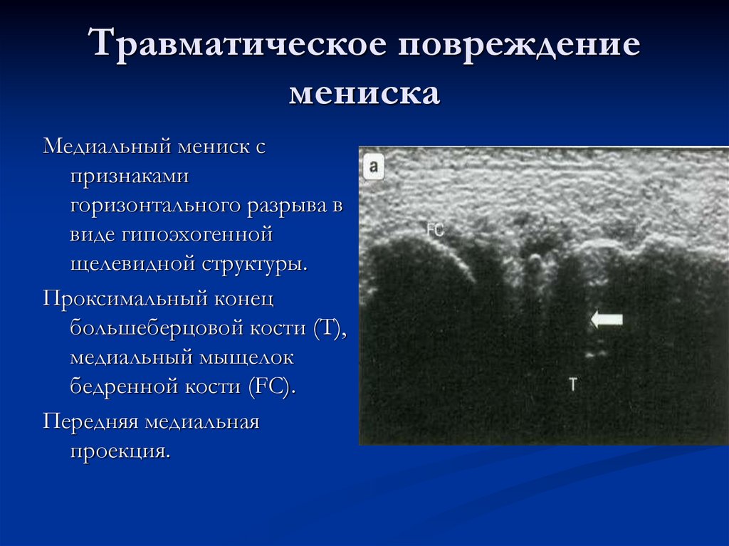 Травматическое повреждение мениска