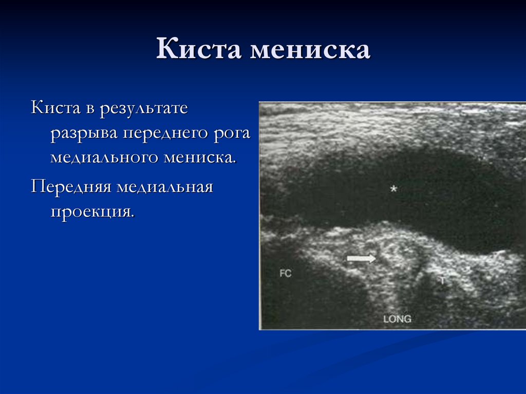 Киста мениска