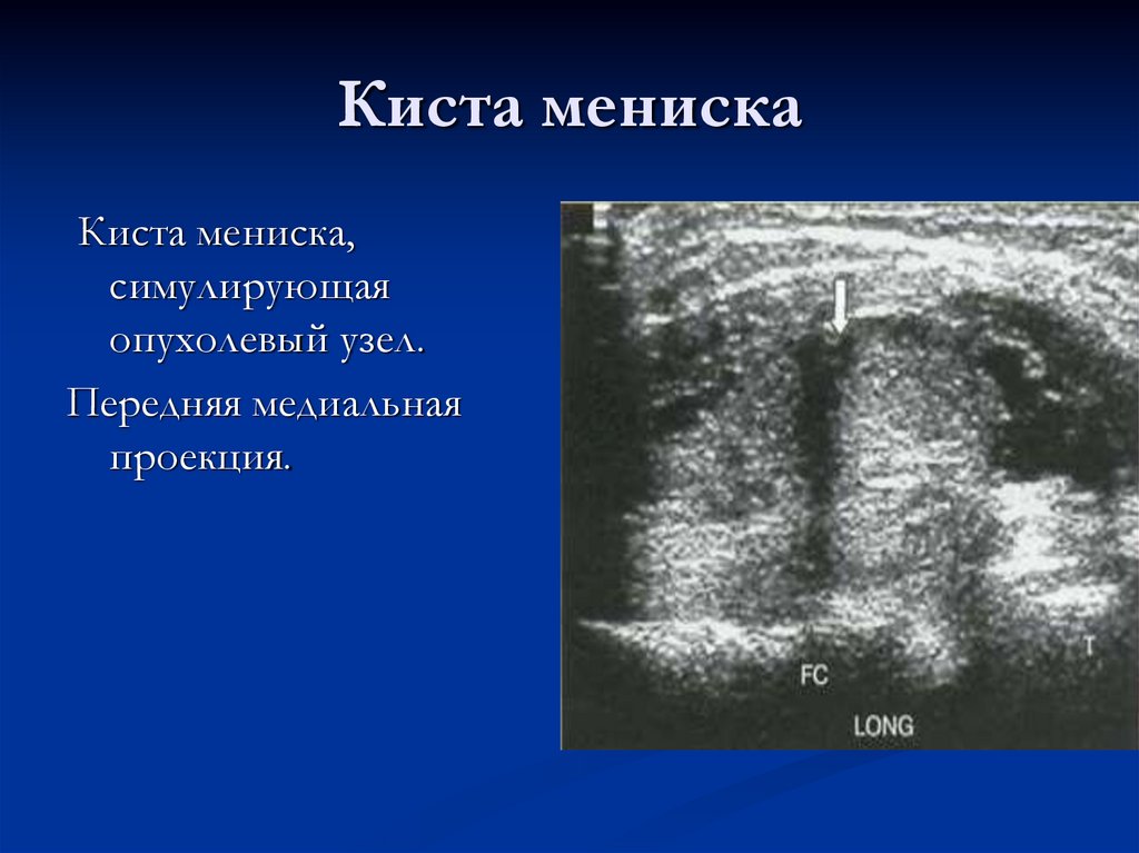 Киста мениска