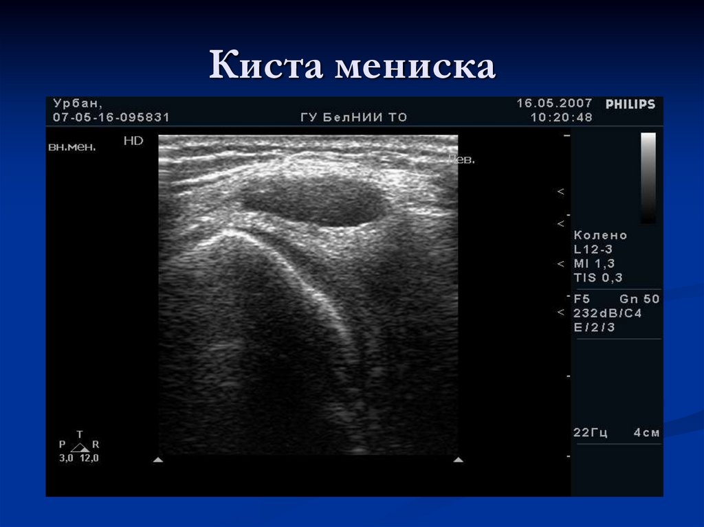 Киста мениска