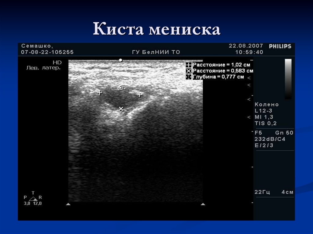 Киста мениска