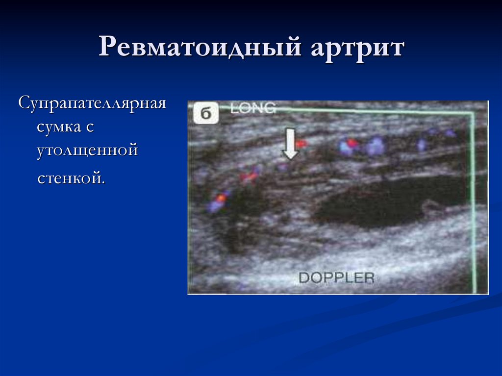 Ревматоидный артрит