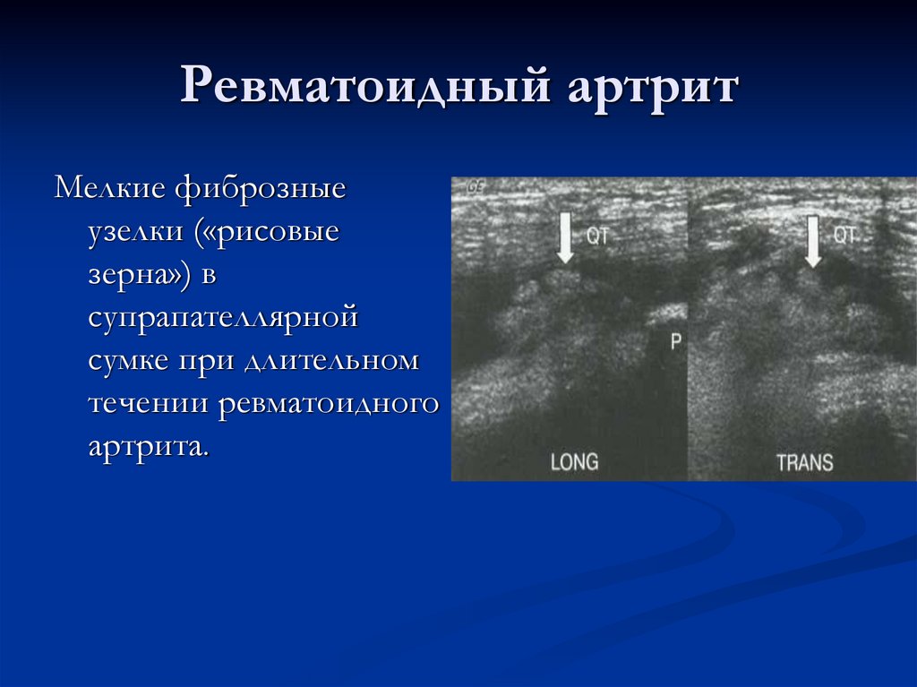 Ревматоидный артрит