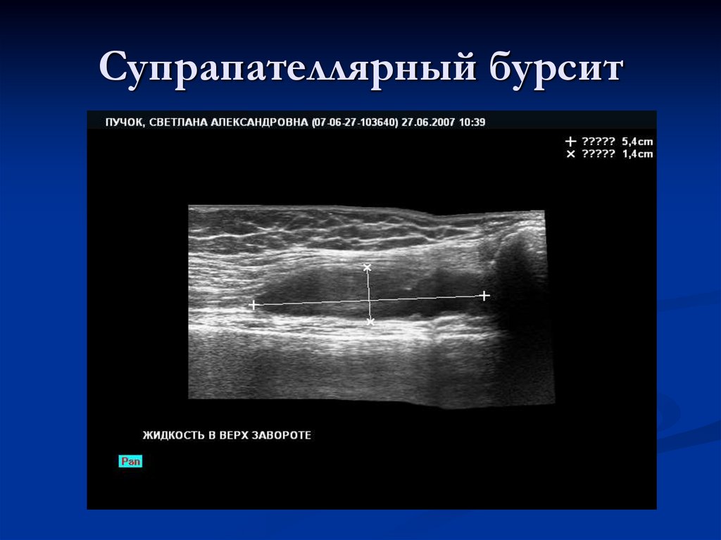 Супрапателлярный бурсит