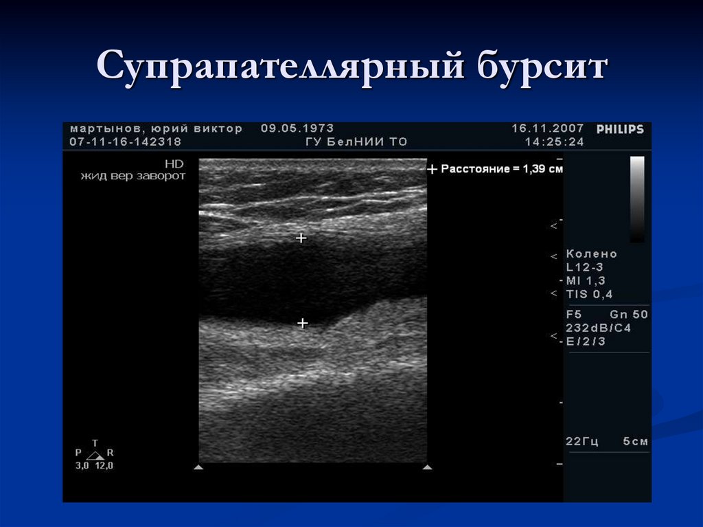 Супрапателлярный бурсит