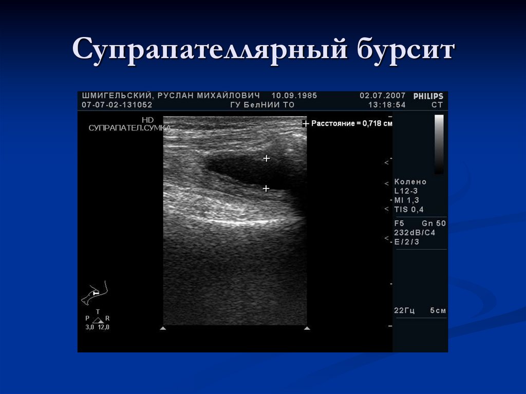 Супрапателлярный бурсит