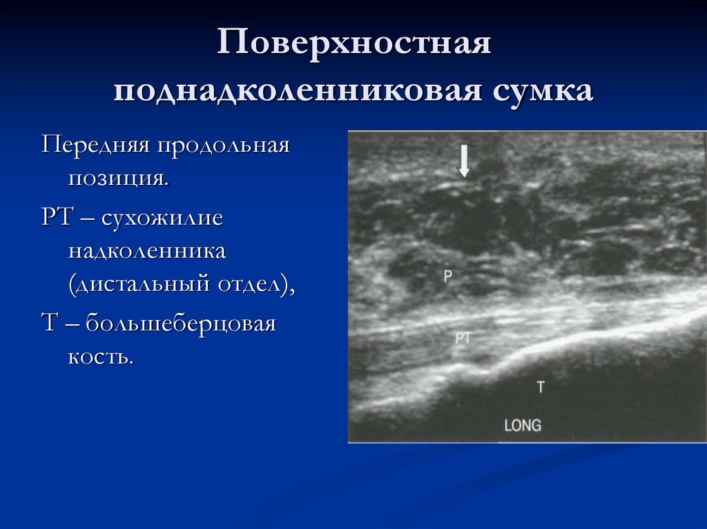 Поверхностная поднадколенниковая сумка