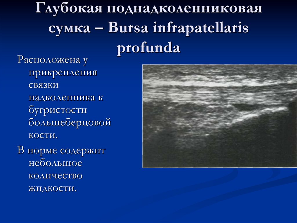 Глубокая поднадколенниковая сумка – Bursa infrapatellaris profunda