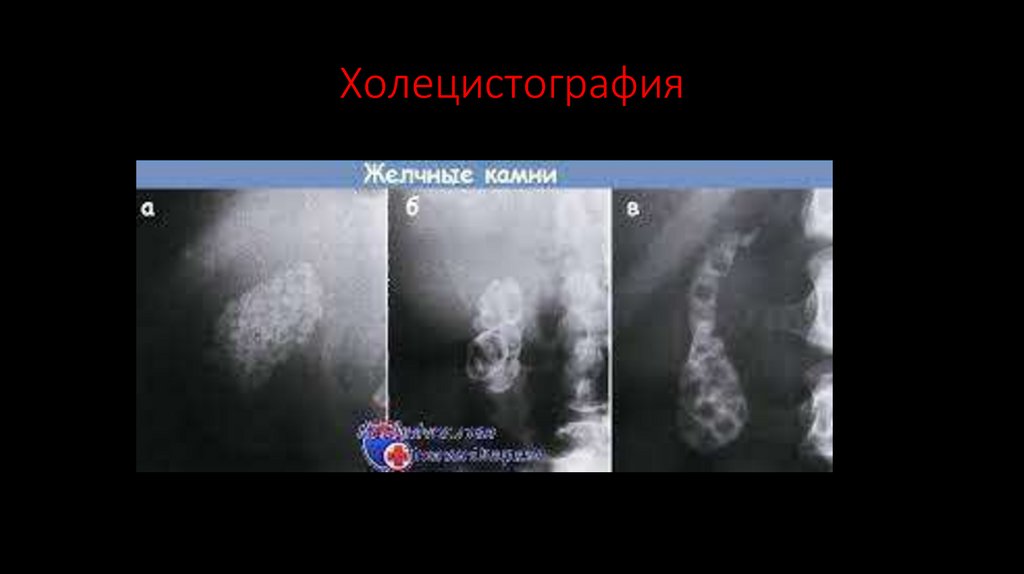 Холецистография