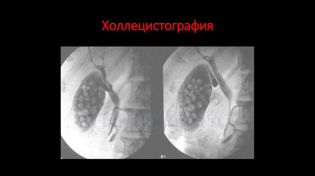 Холлецистография