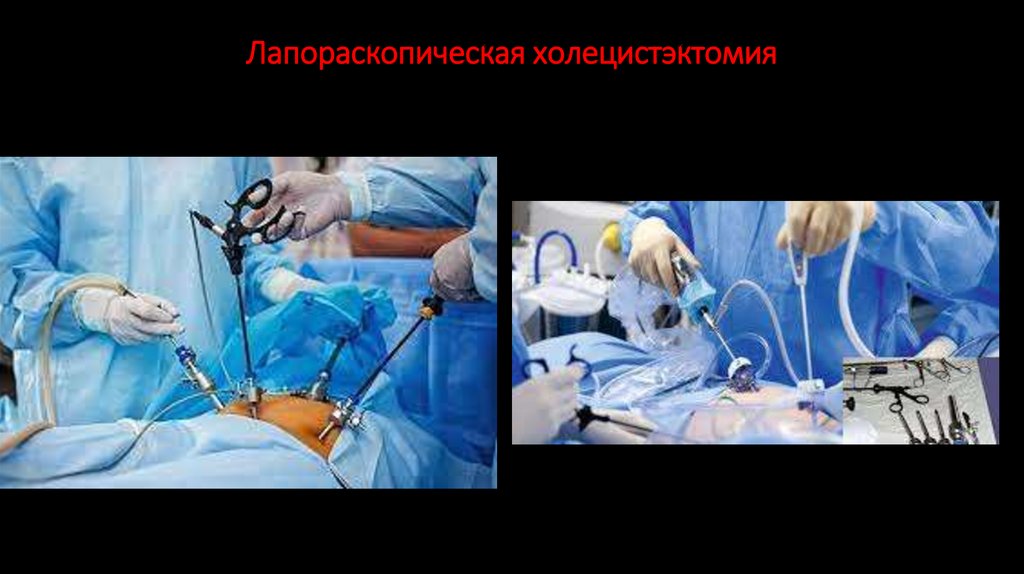 Лапораскопическая холецистэктомия