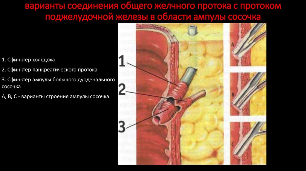 варианты соединения общего желчного протока с протоком поджелудочной железы в области ампулы сосочка