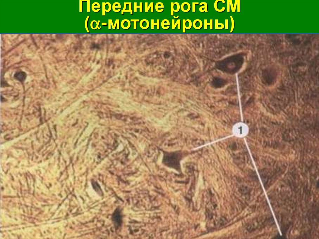 Передние рога СМ (-мотонейроны)