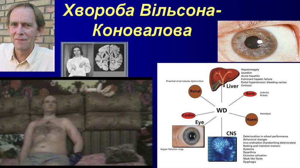 Хвороба Вільсона-Коновалова